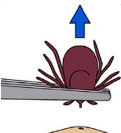Tick Removal